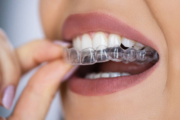 Orthodontic Treatment (Braces & Aligners)