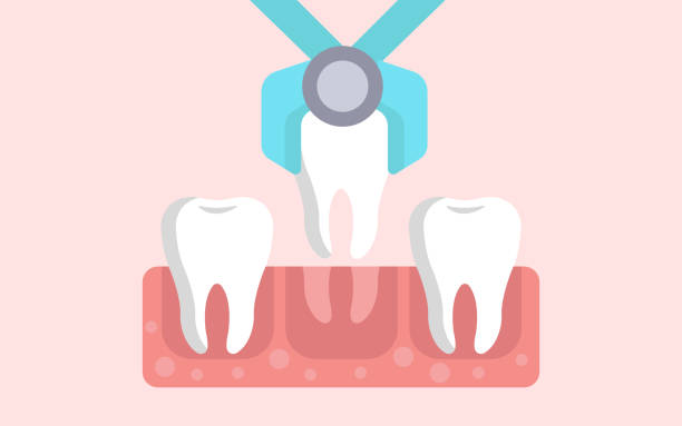 Tooth Extraction